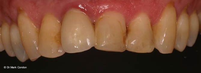 Dental Crowns Dublin - Smile Gallery - The Meath Dental Clinic - case 6 before