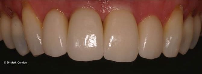 Dental Crowns Dublin - Smile Gallery - The Meath Dental Clinic - Case 6 After