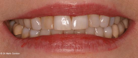 Dental Crowns Dublin - Smile Gallery - The Meath Dental Clinic - Case 5 before