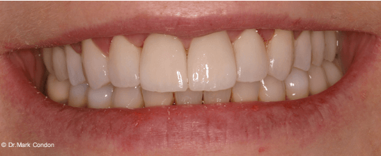 Dental Crowns Dublin - Smile Gallery - The Meath Dental Clinic - Case 5 after