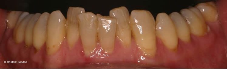 Dental Bridges - Before- Dublin Dentist