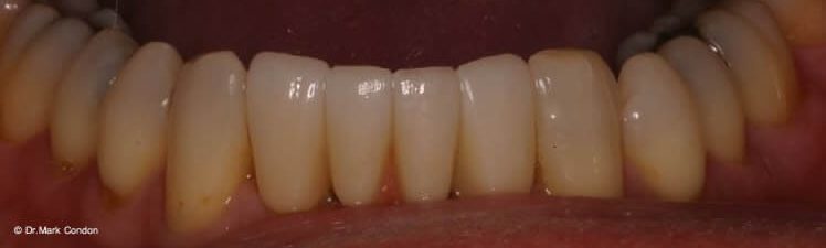 Dental Bridges - After - Dublin Dentist