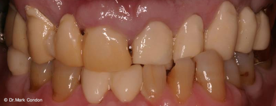 Full Mouth Rehabilitation - Dublin Dentist - case 3 Before
