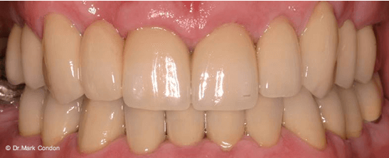 Full Mouth Rehabilitation - Dublin Dentist - case 3