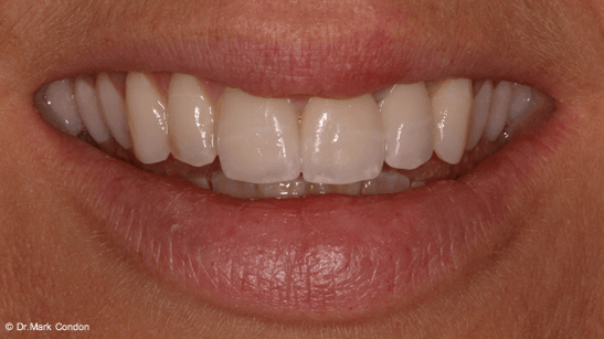 Dental Crowns Dublin - Smile Gallery - The Meath Dental Clinic - Case 5 - after