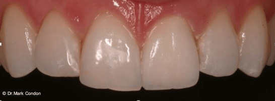 Dental Crowns Dublin - Smile Gallery - The Meath Dental Clinic - Case 3 After