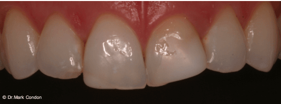 Dental Crowns Dublin - Smile Gallery - The Meath Dental Clinic - Case 3 Before