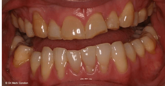 Full Mouth Rehabilitation - Dublin Dentist - case 2 -Before