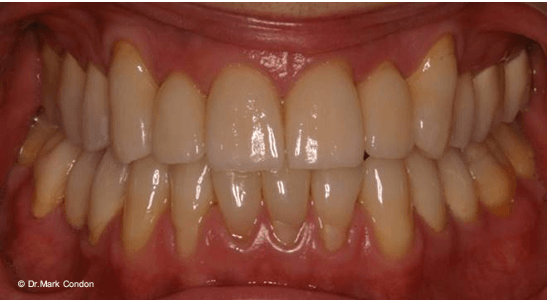 Full Mouth Rehabilitation - Dublin Dentist - case 2 After