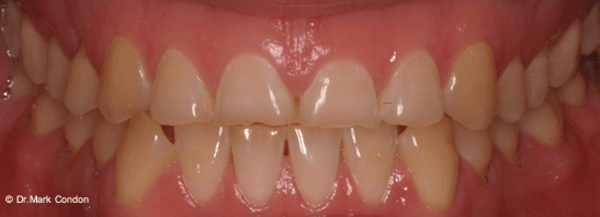 Dental Crowns Dublin - Smile Gallery - The Meath Dental Clinic - Case 4 Before