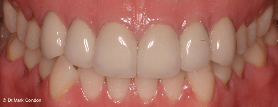 Dental Crowns Dublin - Smile Gallery - The Meath Dental Clinic - Case 4 After