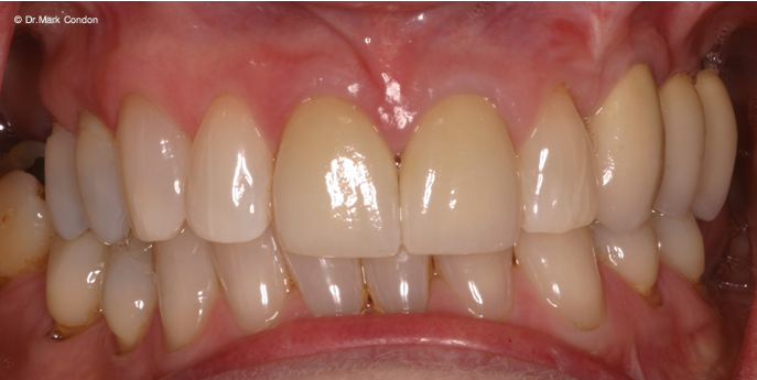 Dental Crowns Dublin - Smile Gallery - The Meath Dental Clinic - case 2 after