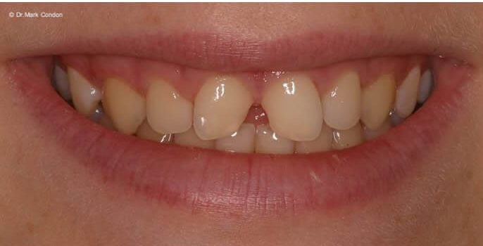 White Fillings - Before - Dublin Dentist